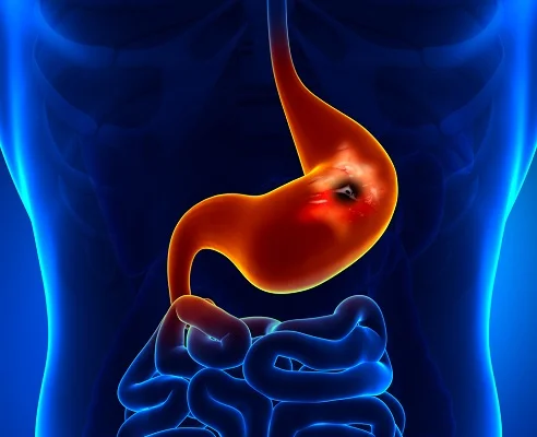 ulcers