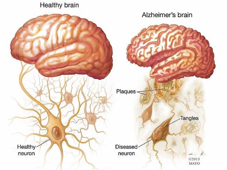 Brain - Genetic Risk Factor of Alzheimer's Disease