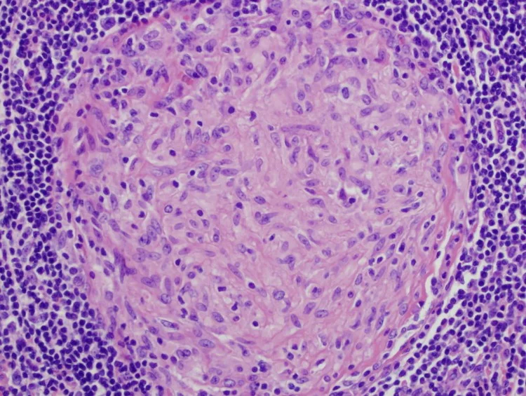 Granuloma