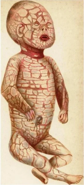 Harlequin fetus