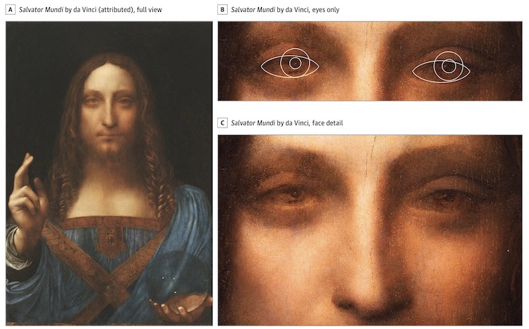 Vision Disorder made Leonardo da Vinci great artist