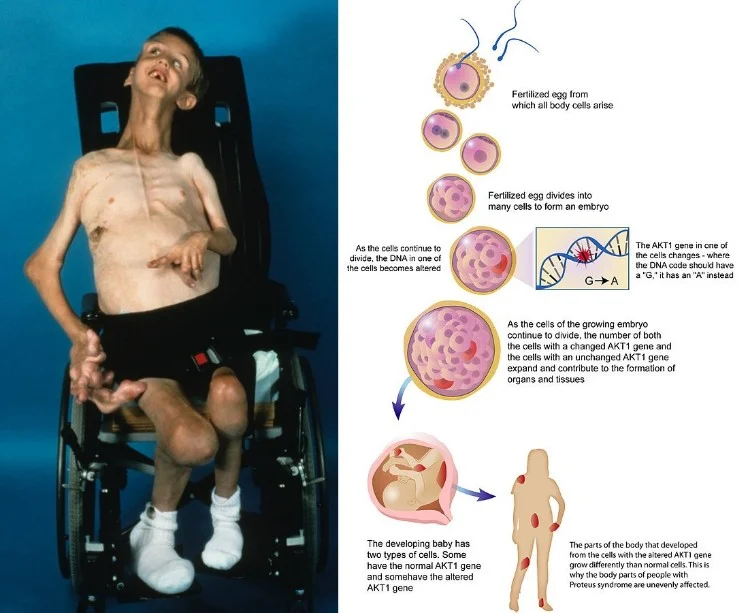 Proteus syndrome