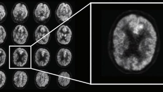 Artificial Intelligence predict alzheimer's disease