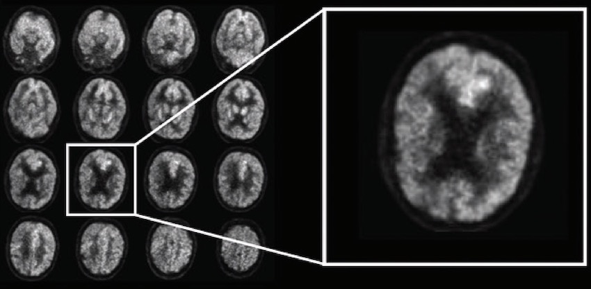 AI Predict Alzheimer's