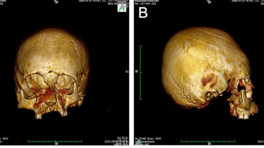 Skulls Deformed Intentionally