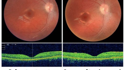 Genes That Cause Blindness Or Cognitive Disorders