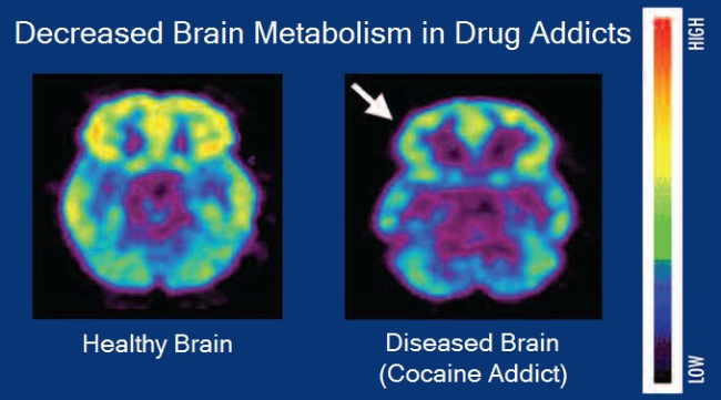 Brain metabolism